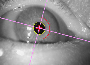 ocular torion measurement